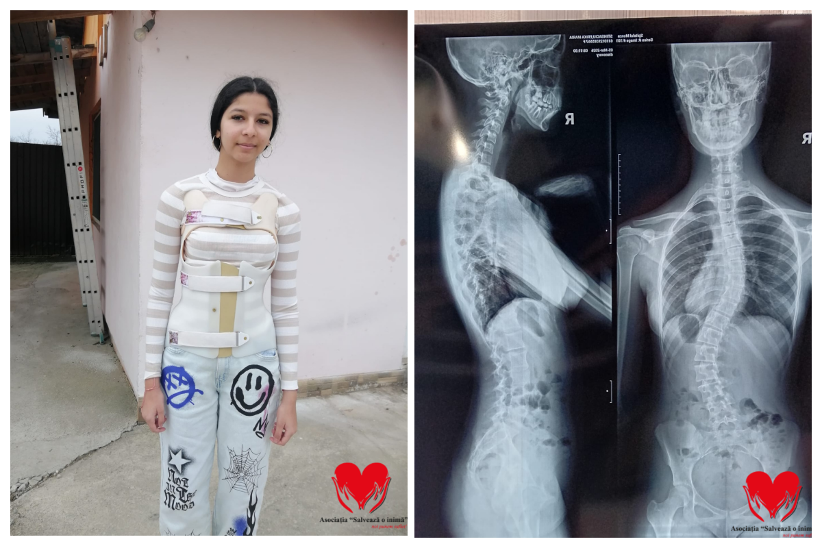 Erika are doar 15 ani si are nevoie urgenta de ajutorul vostru Fiecare zi imi afecteaza coloana vertebrala Vreau sa merg la scoala Operatia este singura mea sansa